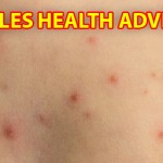 MEASLES HEALTH ADVISORY